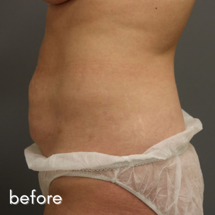 Tummy Tuck Before & After Patient #489