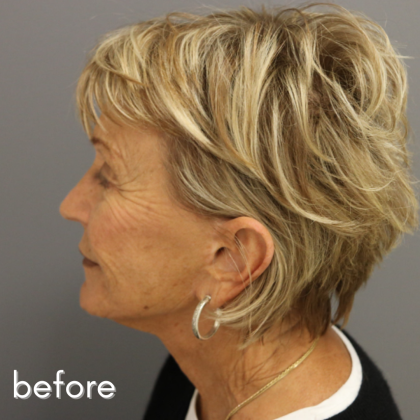 Neck Lift Before & After Patient #544