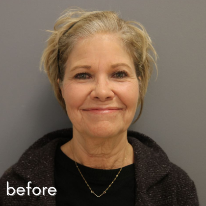 Neck Lift Before & After Patient #552