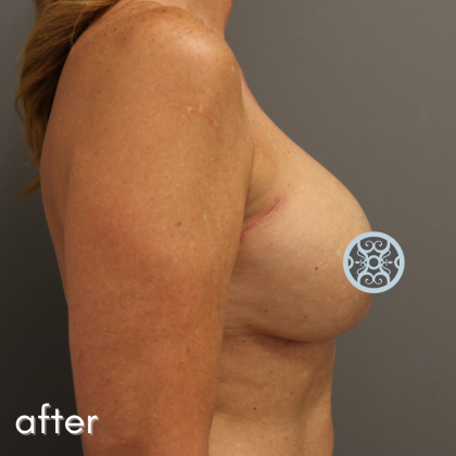 Breast Lift Before & After Patient #569