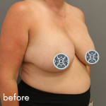 Breast Lift Before & After Patient #574
