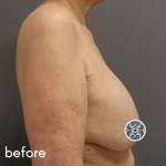 Breast Lift Before & After Patient #584