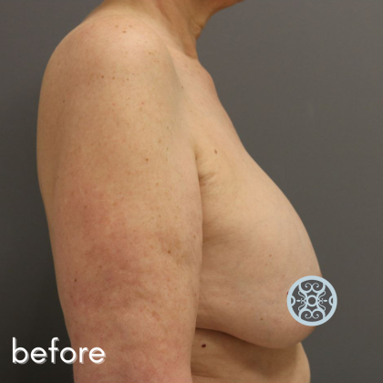 Breast Lift Before & After Patient #584