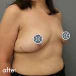 Breast Augmentation Before & After Patient #510