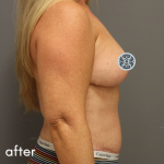 Breast Augmentation Before & After Patient #502