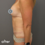 Tummy Tuck Before & After Patient #489