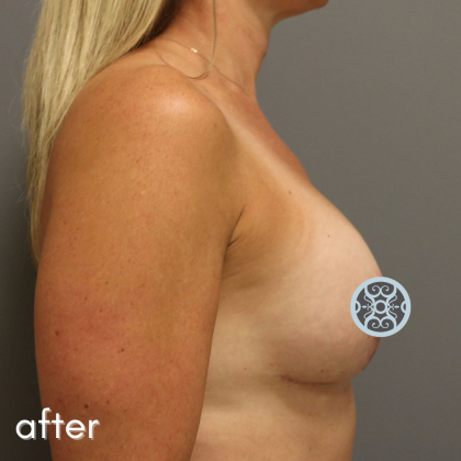 Breast Augmentation Before & After Patient #519