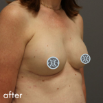 Breast Reconstruction Before & After Patient #529