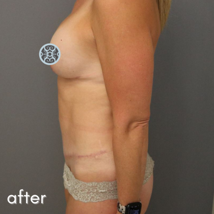 Tummy Tuck Before & After Patient #489
