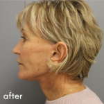 Neck Lift Before & After Patient #544