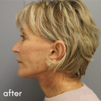 Neck Lift Before & After Patient #544