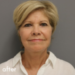 Neck Lift Before & After Patient #552