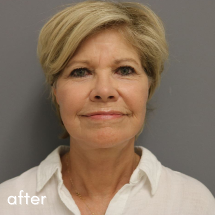 Neck Lift Before & After Patient #552