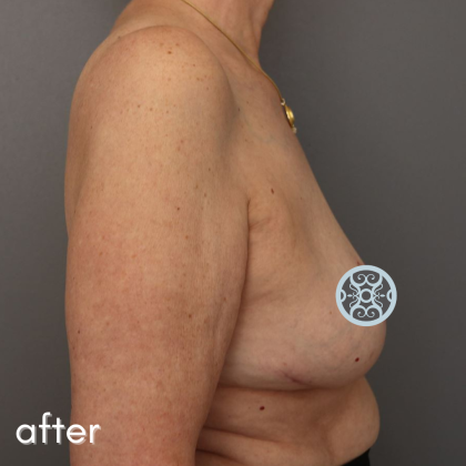 Breast Lift Before & After Patient #584