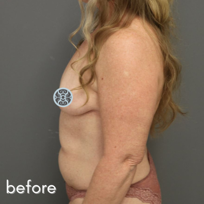Breast Augmentation Before & After Patient #502